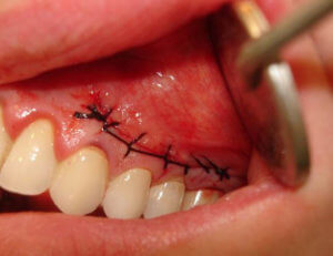 Киста зуба - лечение и удаление в клинике новадент