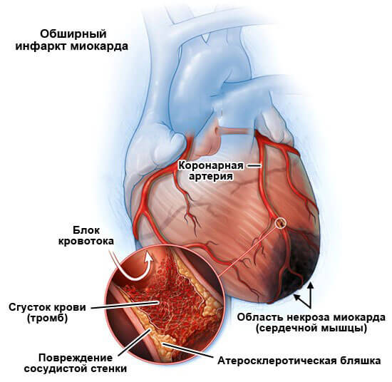Аритмия сердца симптомы лечение первая помощь