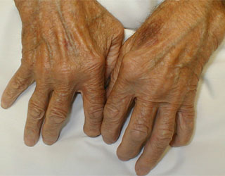 Артрит пальцев рук: симптомы и лечение