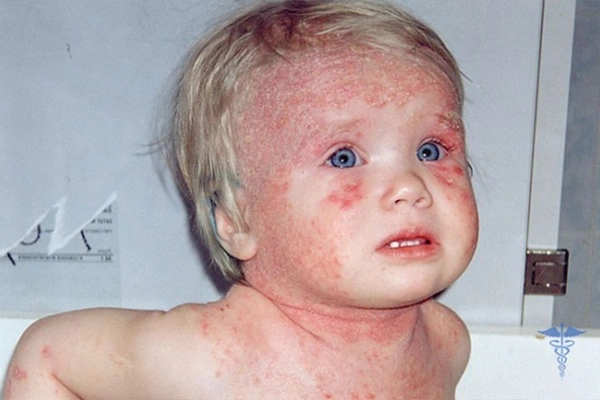 Аллергический дерматит у детей: как правильно лечить, какие симптомы и причины заболевания