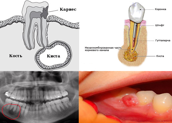 Удаление зуба с кистой на корне — показания, как происходит процедура, боль при удалении