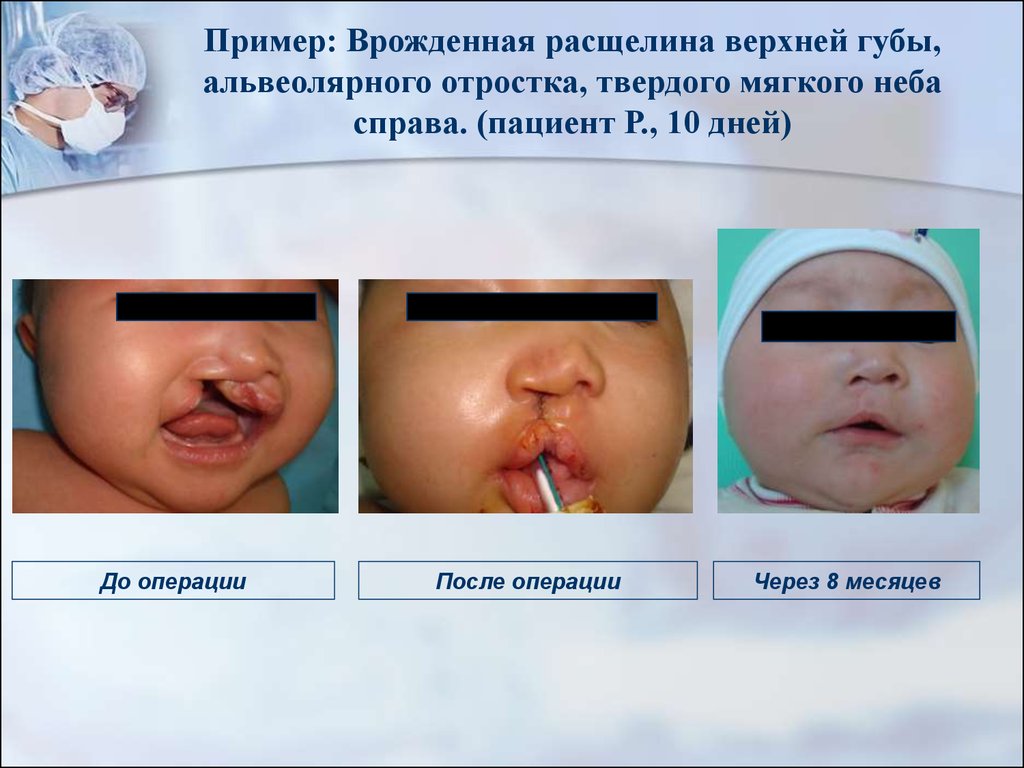 Причины возникновения заячьей губы у новорожденных