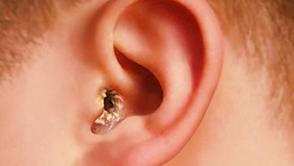 Грибок в ушах: лечение, симптомы, причины отомикоза