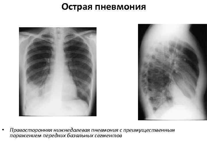 Поражения правого легкого. Внебольничная нижнедолевая пневмония рентген. Правосторонняя очаговая пневмония рентген. Пневмония нижней доли правого легкого рентген. Крупозная и очаговая пневмония рентген.