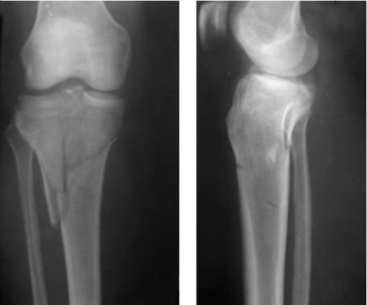 Экзостоз коленного сустава у детей операция нужно ли делать