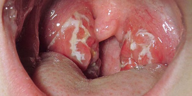 Воспаление миндалин в горле симптомы