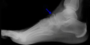 Остеохондропатия ладьевидной кости стопы: причины