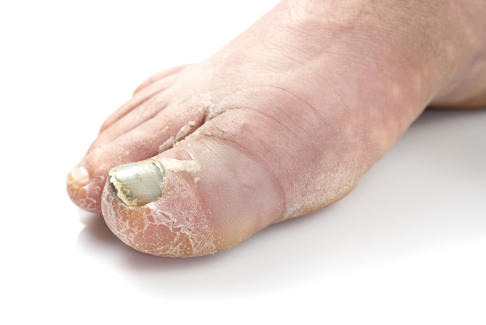 ﻿грибок ногтей на ногах — лечение, лекарства, профилактика