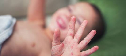 Аллергия на манту у детей и взрослых: причины, симптомы и лечение