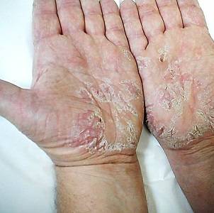 Нервный дерматит: крапивница на нервной почве, аллергия и сыпь от стресса на коже, как лечить