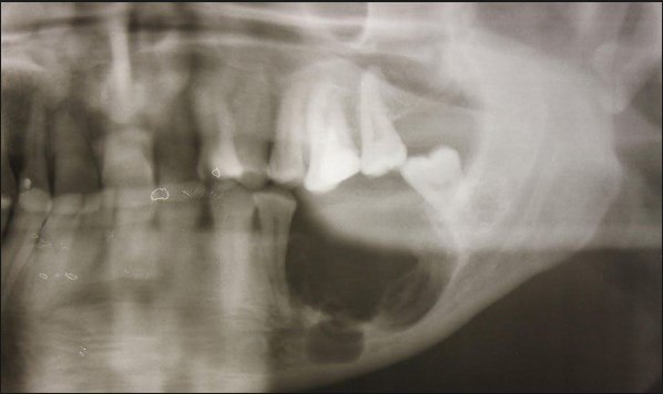 Одонтогенный остеомиелит челюсти - хирургическая стоматология от а до я
