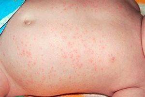 Аллергия на чеснок: может ли быть такое у взрослых и детей, как проявляются симптомы, а также фото недуга на коже и советы, чем стоит его лечить