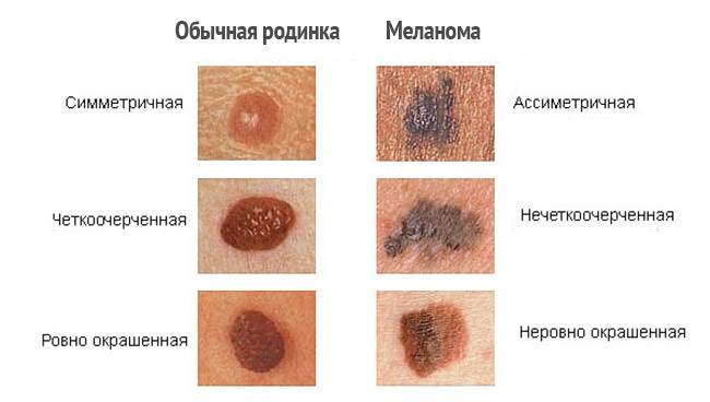 Меланома кожи – как выглядит рак кожи (фото)? меланома кожи – стадии по тнм, симптомы и признаки